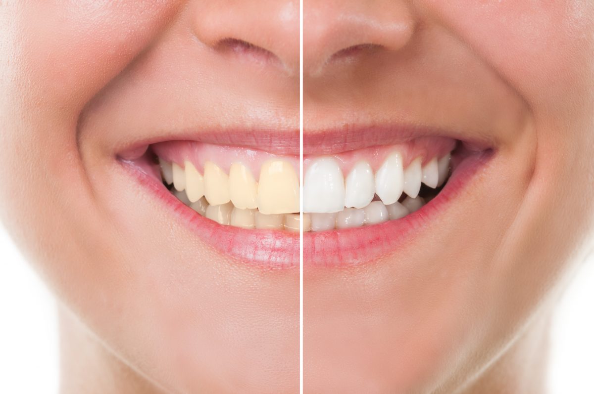 What to Expect with Teeth Whitening in Newport Beach CA